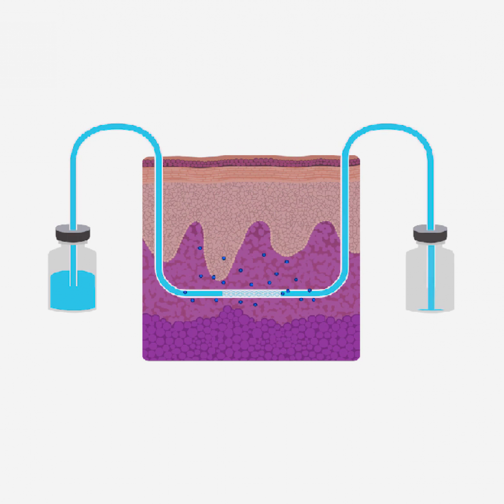 ImmUniverse releases short video on dermal open-flow microperfusion (dOFM)